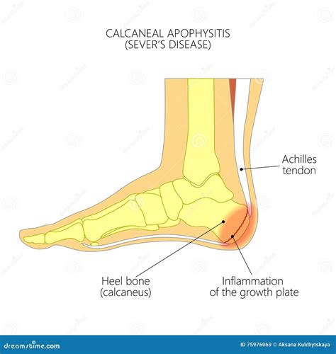 Calcaneal Apophysitis stock vector. Illustration of inflammation - 75976069