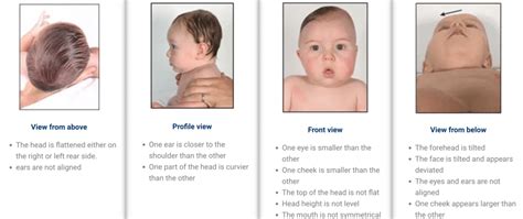 Difference between plagiocephaly and brachycephaly