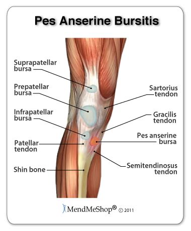 Pes Anserine Tendinitis