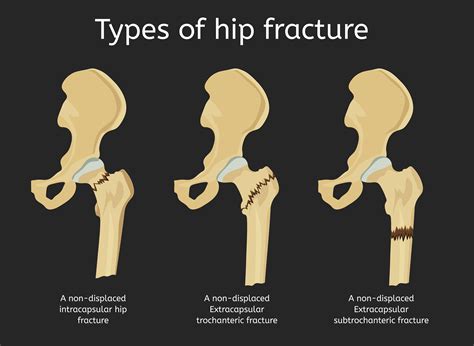 Effectiveness of weekend physical rehab for functional recovery in ...