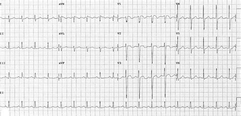 Pe ecg findings - nipodthat