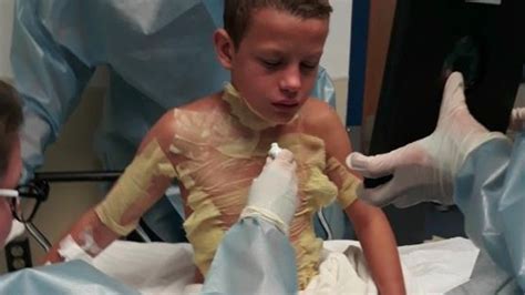 Boy suffers second-degree burns in ‘fire challenge’ - Boston News ...