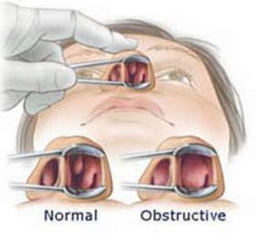 Turbinate Reduction - Fort Worth ENT & Sinus