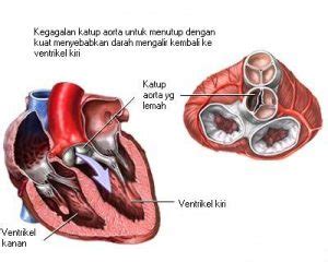 ciri-ciri jantung rematik | SayangHidup.com