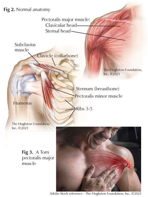 Pectoralis Major Muscle Injuries - Hughston Clinic