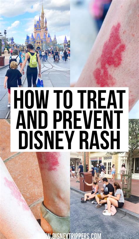 How to treat and prevent disney rash pictures tips and more – Artofit