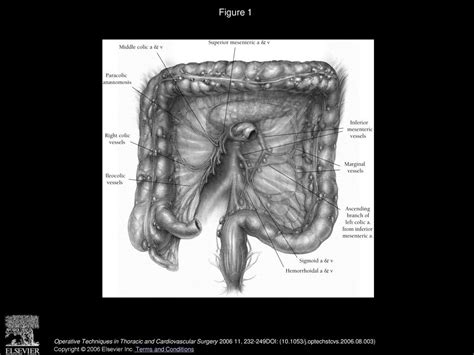 Colonic Interposition for Benign Disease - ppt download