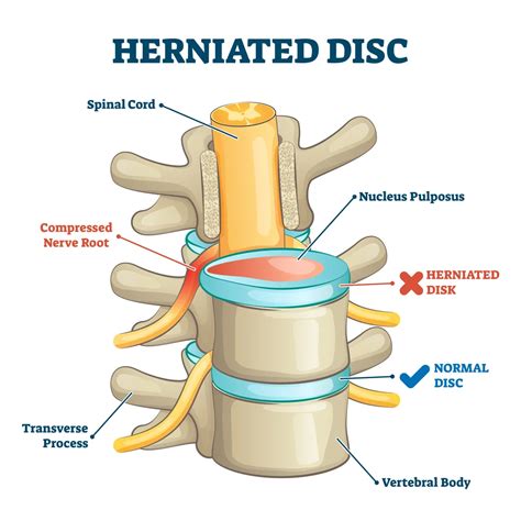 L4 L5 Disc Herniation Explained | Premia Spine