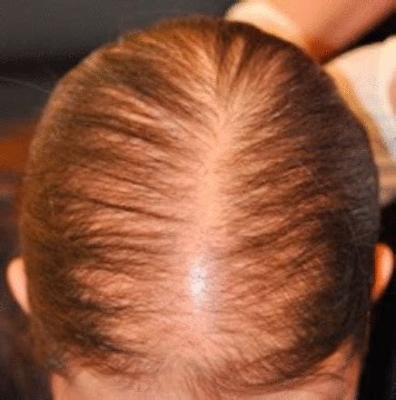 Alopecias in lupus erythematosus | Lupus Science & Medicine