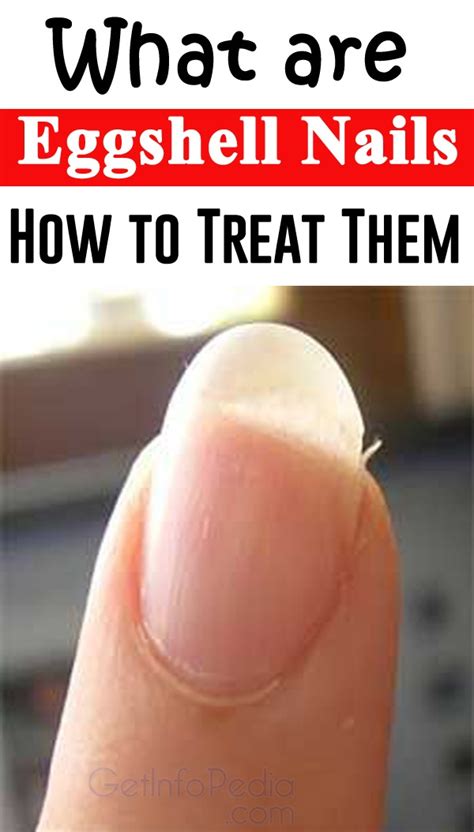 What are Eggshell Nails? - How to Treat Them? - Getinfopedia.com