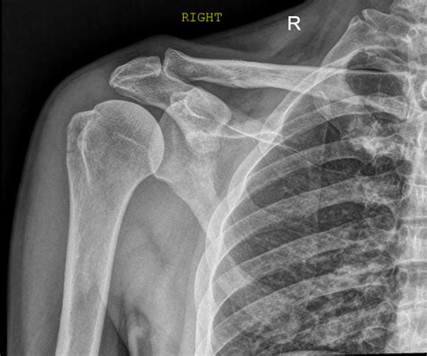 Greater Tubercle Of Humerus Palpation