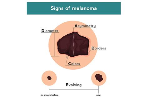 ABCDE of Skin Cancer | Cone Health