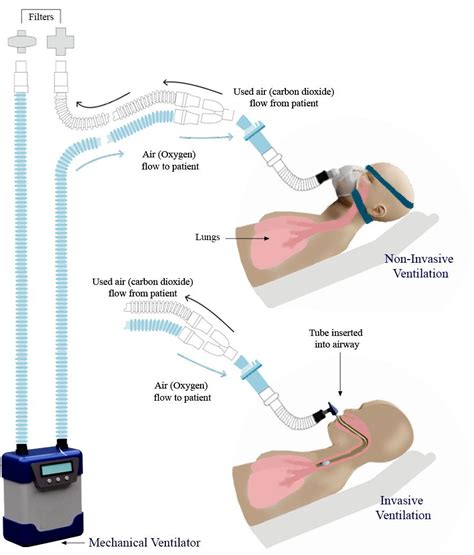 DIY Ventilators for COVID-19 Could Be a Vital Stopgap - IEEE Spectrum