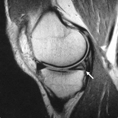 Meniscus Injuries | Seattle, WA