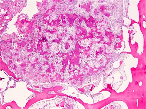 Osteoid Osteoma Histology