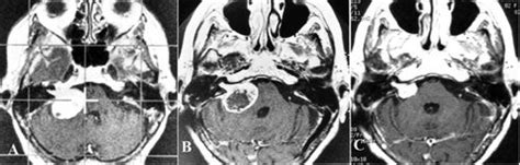 Acoustic Neuromas (Vestibular Schwannoma) - Neurosurgery