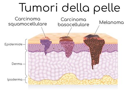 Tumori della pelle: immagini, sintomi, pericoli e sopravvivenza