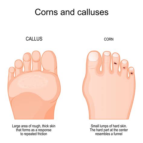 Corns & Calluses | Nova Family Podiatry