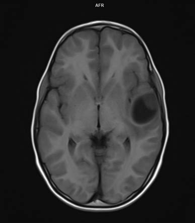 Pleomorphic xanthoastrocytoma | Radiology Case | Radiopaedia.org