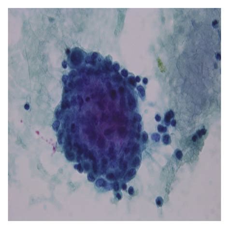 Pleural fluid cytology, PAP stain (×40): mesothelial cells with ...