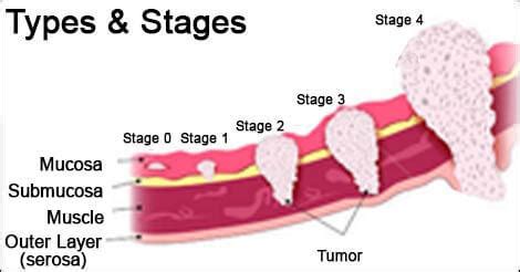 Difference Between Stage 1 And Stage 2 Cancer - CancerWalls