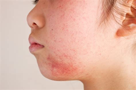 Dermatitis Treatments | U.S. Dermatology Partners