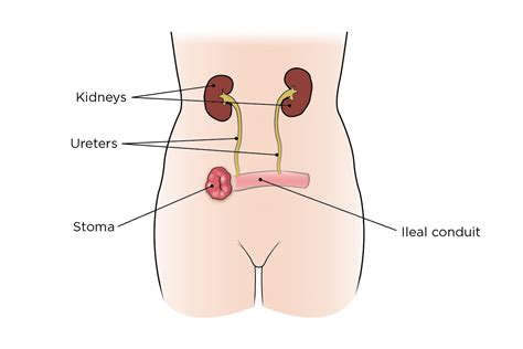 Bladder Cancer Surgery | Memorial Sloan Kettering Cancer Center