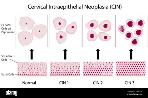 Cervical dysplasia stages and pap smear test Stock Photo - Alamy