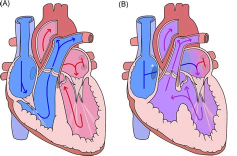 Tricuspid atresia: Where are we now? - Sumal - 2020 - Journal of ...