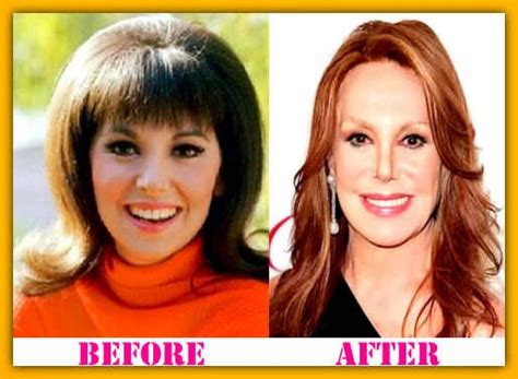 Marlo Thomas Plastic Surgery Nose Job Before and After Facelift, Botox ...