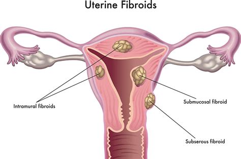 Uterine fibroids - symptoms, treatments and causes | healthdirect