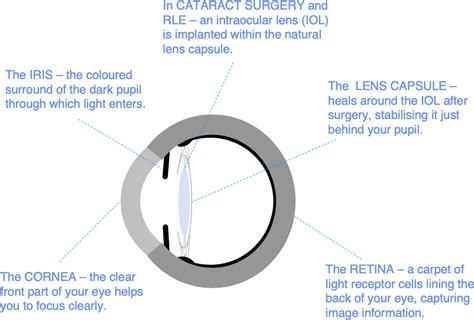 YAG laser capsulotomy