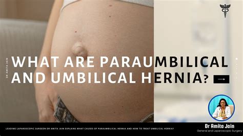 Paraumbilical and Umbilical Hernia Repair Surgery - YouTube