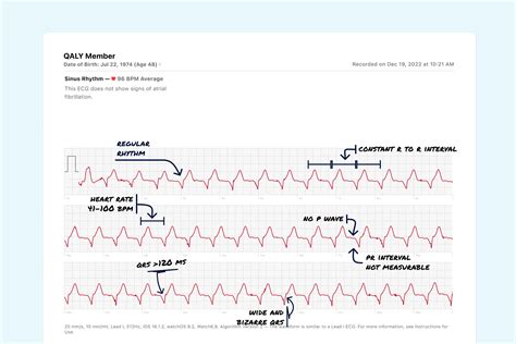 Accelerated Idioventricular Rhythm Vs. Premature Ventricular ...