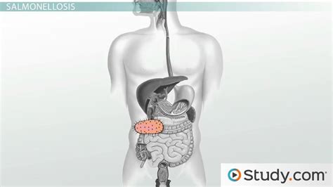 Salmonella Poisoning | Symptoms, Diagnosis & Treatment - Lesson | Study.com