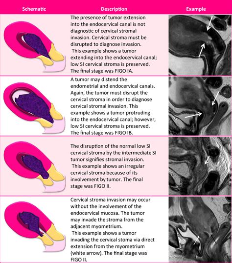 Endometrial Cancer MRI staging: Updated Guidelines of the European ...