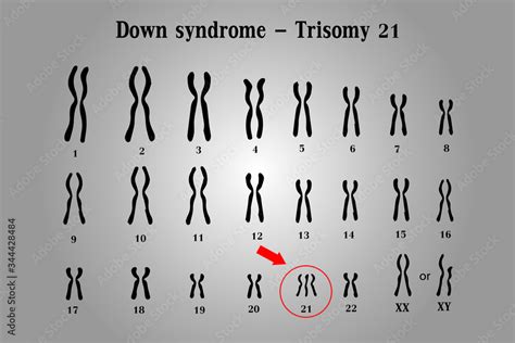 Karyotype of Down syndrome (DS or DNS), also known as trisomy 21, is a ...