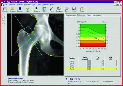 O exame que permite o diagnóstico precoce da osteoporose e da ...