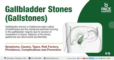 Gallstones, Gallbladder Stones – Symptoms, Causes, Complications