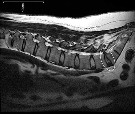 Mri Lower Back Pain