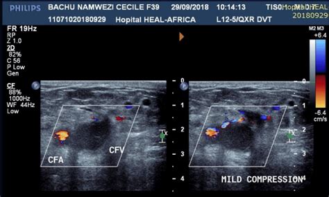 Blood Clot In Arm Ultrasound