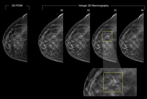 3D Mammograms (3D Breast Imaging / Tomosynthesis) on Long Island