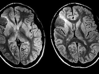 Lissencephaly – Symptoms, Causes, Treatment, Preventions, Diagnosis