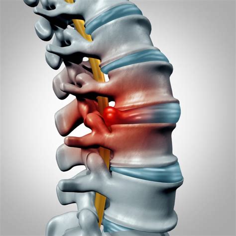 Healing a Moderate L5-S1 Disc Herniation: Expert Tips | MN Spine Institute