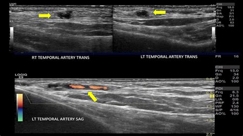 Temporal Artery Ultrasound