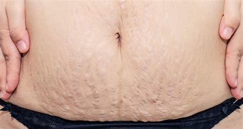 Simple But Very Effective Ways To Remove Stretch Marks After Pregnancy ...