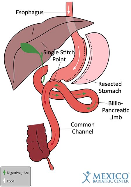 Single-Loop Duodenal Switch (SADi-S) vs DS - Mexico Bariatric Center