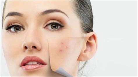 Pimples before a party or special day? Here are 5 overnight quick-fix ...