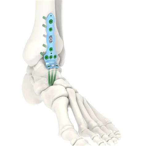 Ankle Arthrodesis - Siora Surgicals Private Limited - Manufacturer and ...