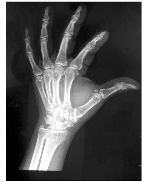 Arthrodesis postoperation | Download Scientific Diagram